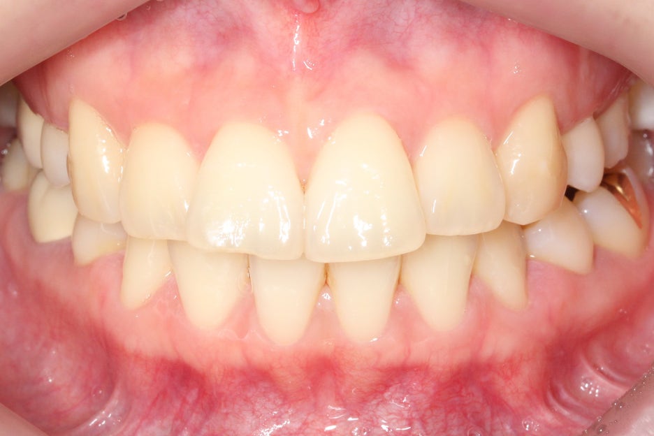 토끼앞니교정 부분교정으로 단기완성 관련 이미지 1