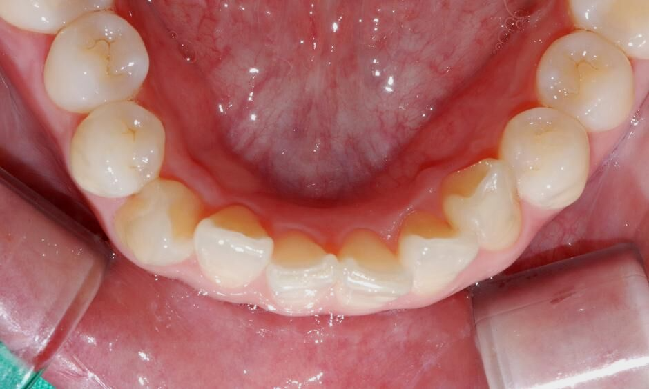 강남역치과[투디치과]투명교정/급속교정 관련 이미지 4