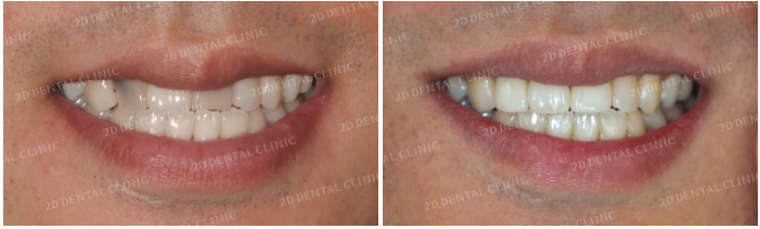 앞니라미네이트 잘하는 곳 : 2D치과 관련 이미지 5