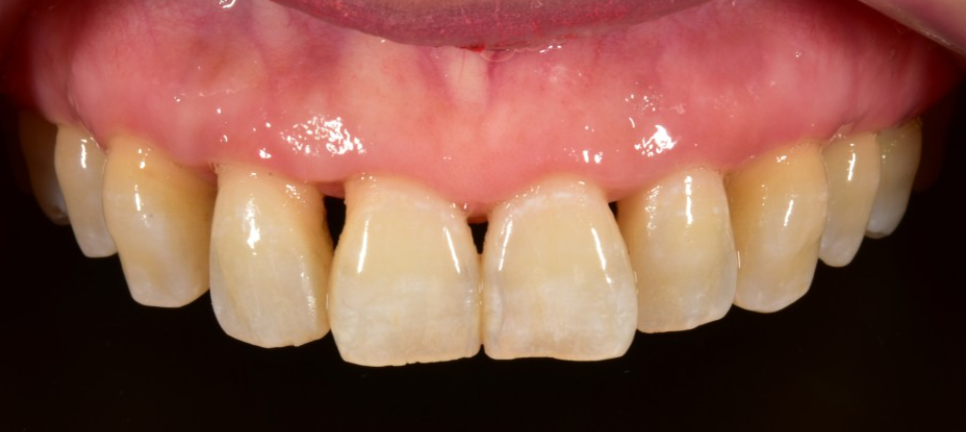 연예인라미네이트 블랙필름 무삭제라미네이트가격 관련 이미지 3