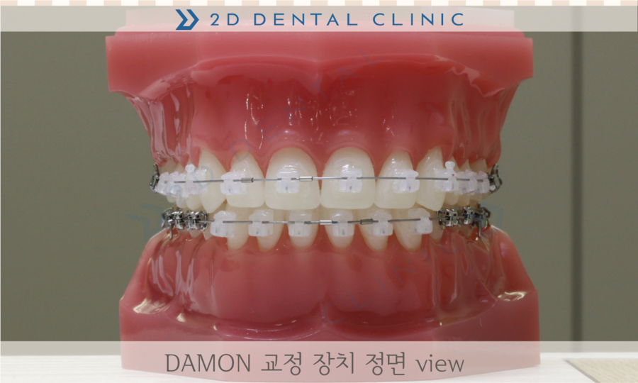 [교정상식] 전체교정 장치 종류 및 장단점! 관련 이미지 3