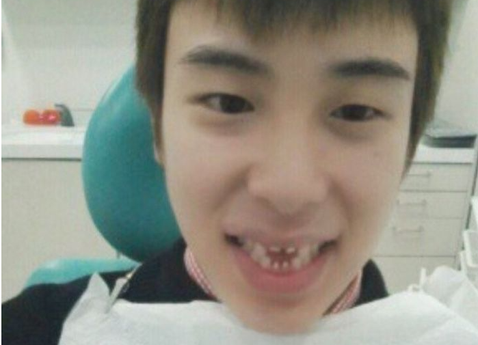 라미네이트 빠짐 대처법 관련 이미지 4