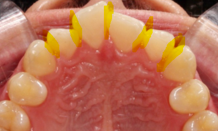 부분교정으로 삐뚤어진 앞니 예뻐지는 방법 관련 이미지 12