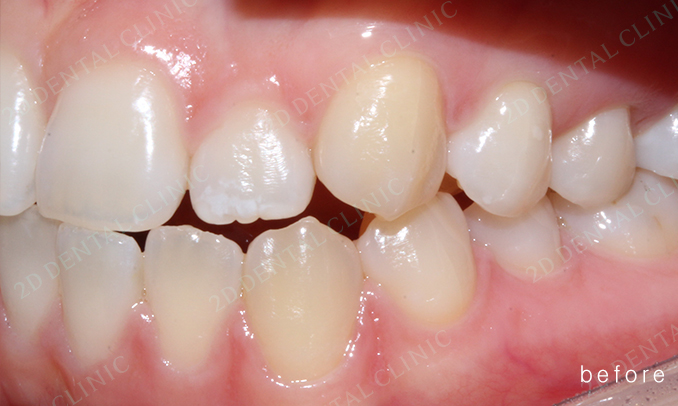 우디의 교정 일기ㅣ부정 교합 치아교정 후기 관련 이미지 4