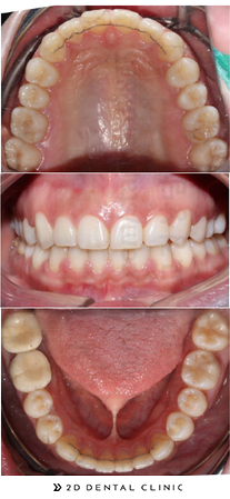 비발치교정, 발치 없이 교정하기! 강남 2D치과 관련 이미지 5