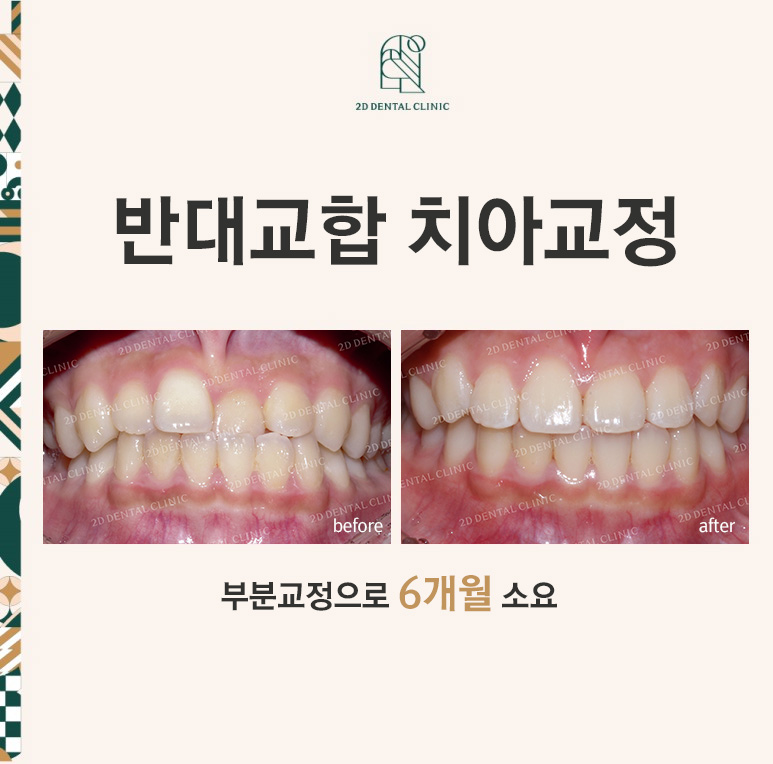 반대교합 치아교정, 앞니를 가지런하게! by.투디치과(2D치과) 관련 이미지 1
