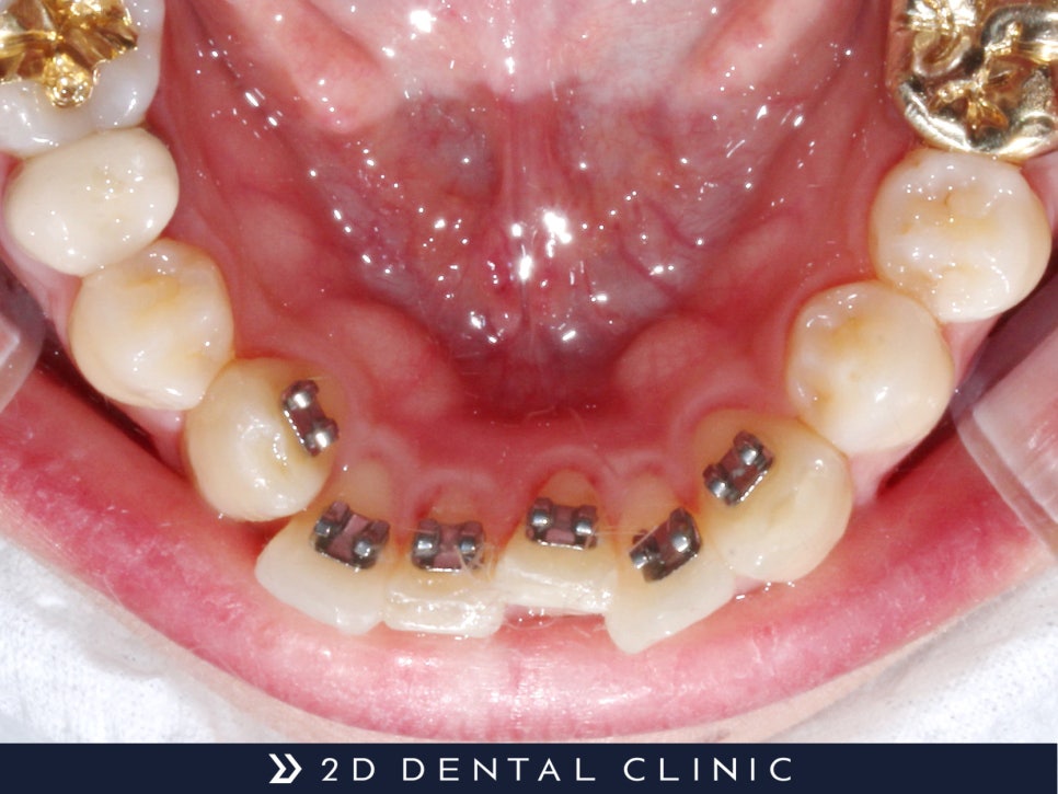 아랫니 부분교정, 2D치과에서 2D교정! 관련 이미지 3