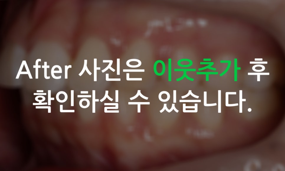 세라믹교정 앞니틀어짐 교정 사례 관련 이미지 10