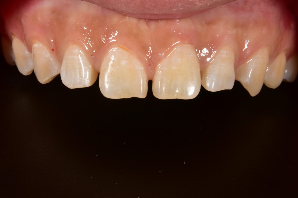 [투디치과] 블랙필름(비스포크) 치료의 다양한 사례 관련 이미지 12