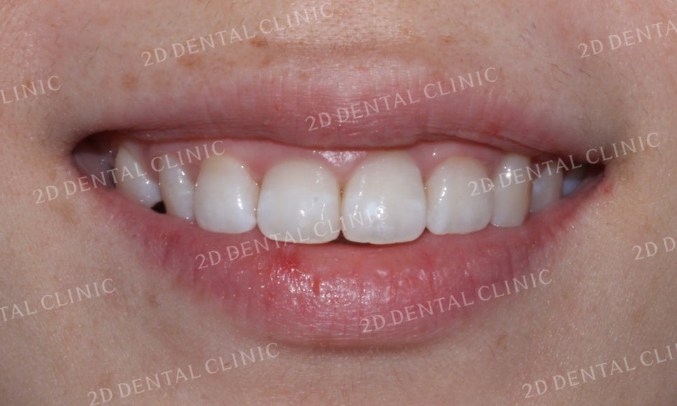 [투디교정] 덧니교정, 앞니교정으로 치열을 고르게! by.투디치과(2D치과) 관련 이미지 10