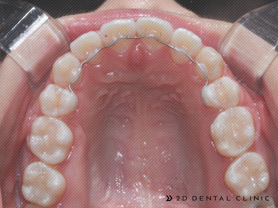 절단교합 교정 케이스 전후비교, 교정전문 2D치과 관련 이미지 9