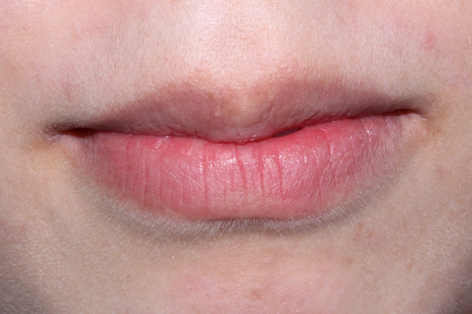 왜소치 뻐드렁니 교정 신논현역치과에서 관련 이미지 1