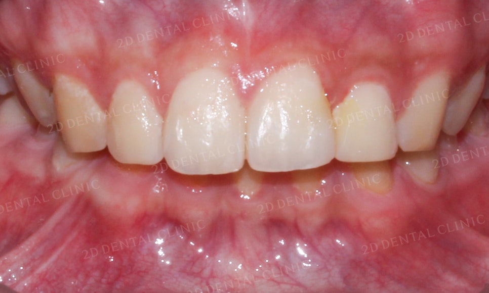 [앞니교정] 벌어진 앞니, 부분교정으로 앞니교정하기! by.2D치과(투디치과) 관련 이미지 14