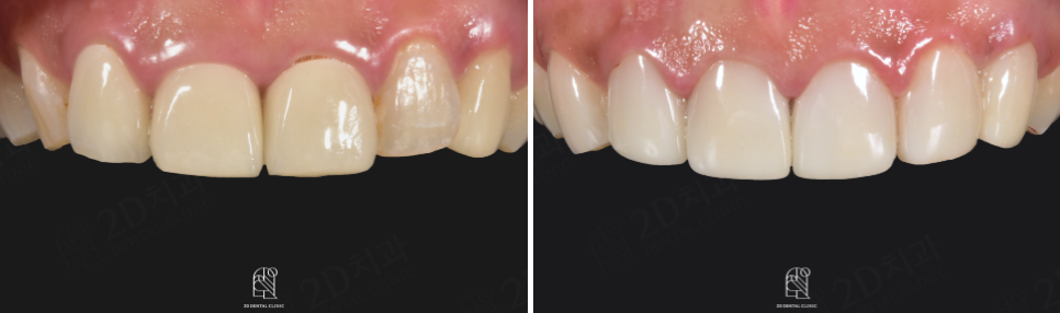 무삭제블랙필름 실제 후기 관련 이미지 13
