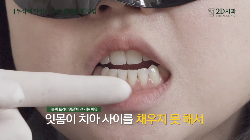 [블랙필름 상담받고 왔어요] #3 앞니가 깨졌어요 관련 이미지 17