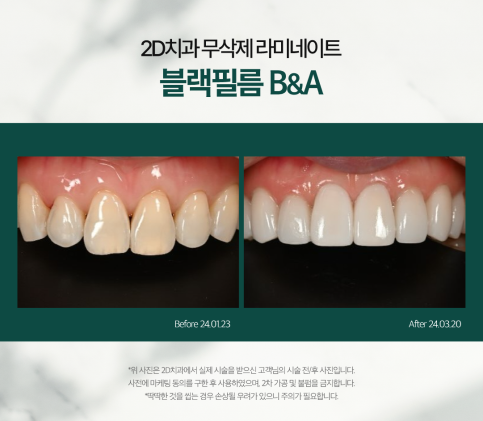 대구무삭제라미네이트 심미치료 숨기지 말고 당당하게 미소 짓기 관련 이미지 7