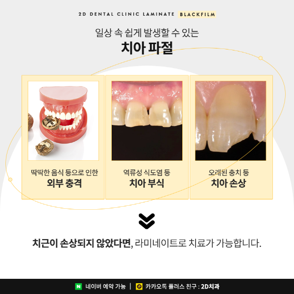 "깨진 앞니 방치하면 안 돼요!" 2D치과 맞춤 치료법 관련 이미지 2