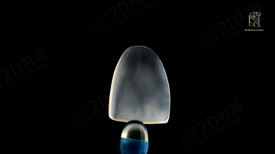 무삭제 라미네이트 교정 고민중이라면? 관련 이미지 4