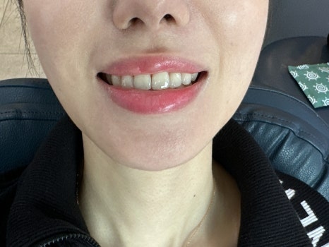 무삭제라미네이트 블랙필름 케이스 비포 에프터 후기 관련 이미지 2