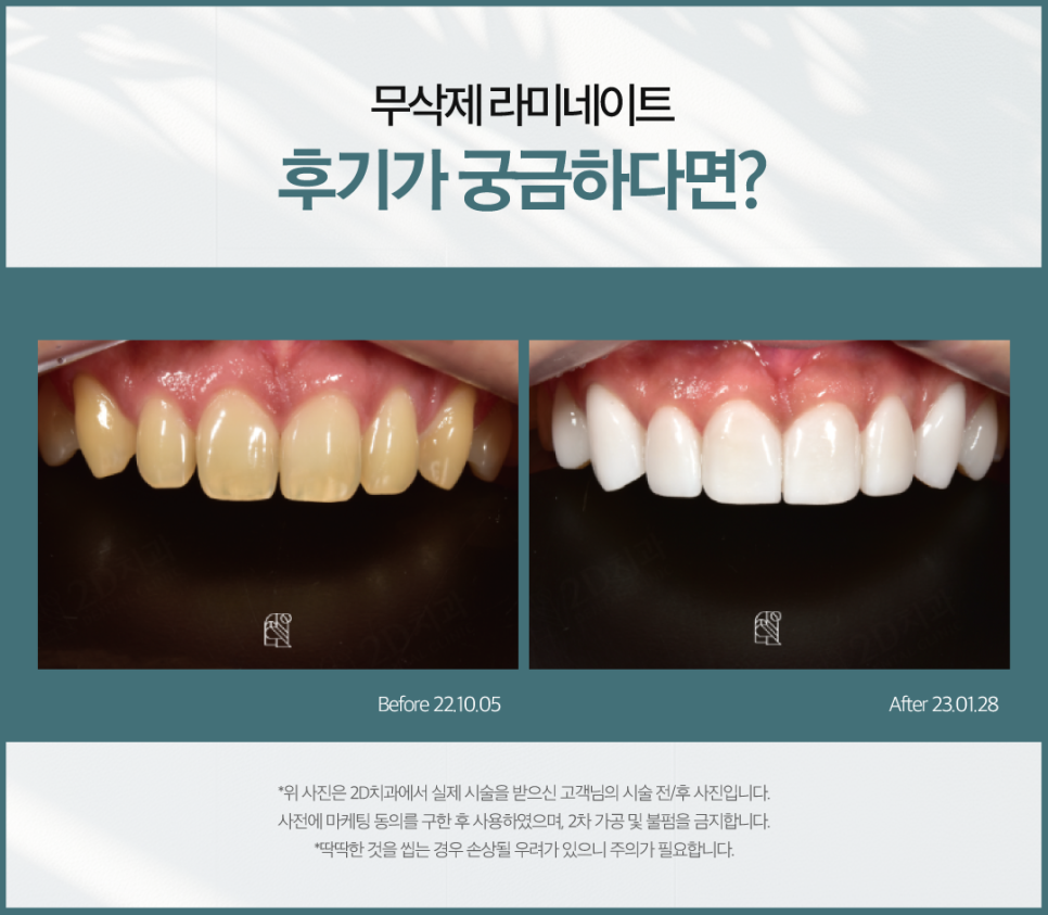 무삭제라미네이트부작용 치아미백치과 누런 이 치료, 망설여진다면 관련 이미지 7