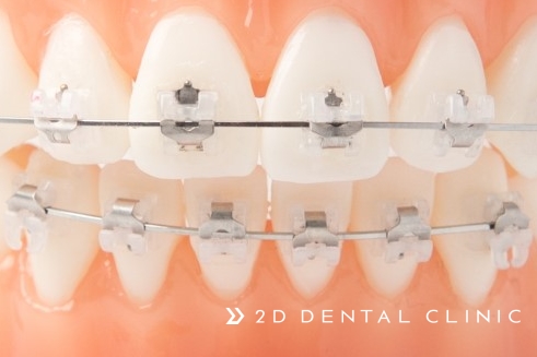 2D교정? 클리피씨? 자가결찰 브라켓! 강남 투디치과 관련 이미지 5