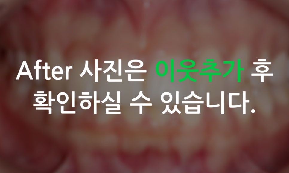 세라믹교정 앞니틀어짐 교정 사례 관련 이미지 8