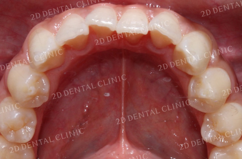 돌출입, 돌출앞니를 부분교정으로 고르게! by.투디치과(2D치과) 관련 이미지 4