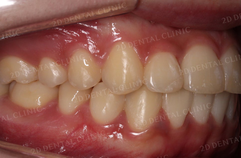 [앞니교정] 토끼앞니교정, 클리피씨 교정으로 완벽하게! by.투디치과(2D치과) 관련 이미지 13