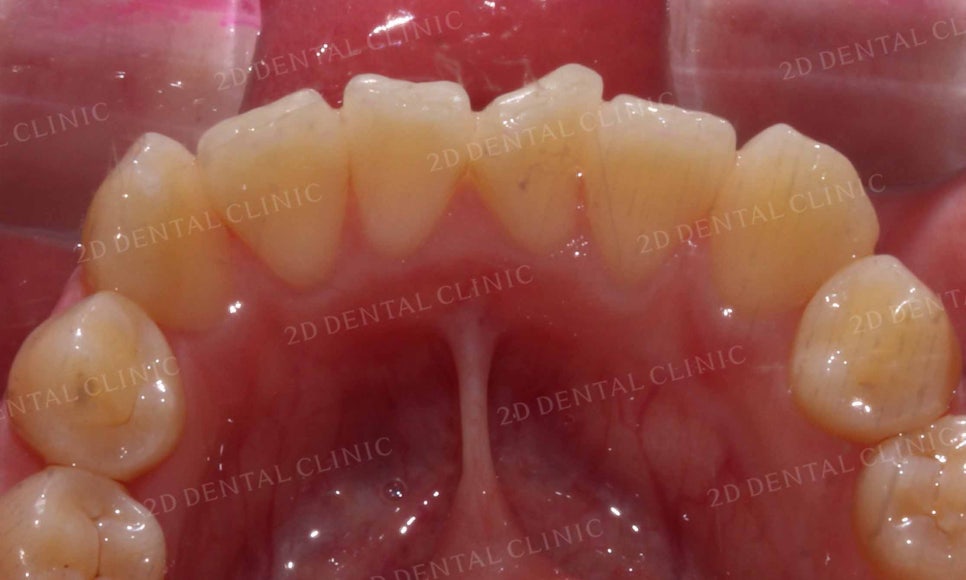 강남역 치과에서 앞니부분 설측 2D(투디)교정으로 토끼앞니 탈출한 후기 관련 이미지 7