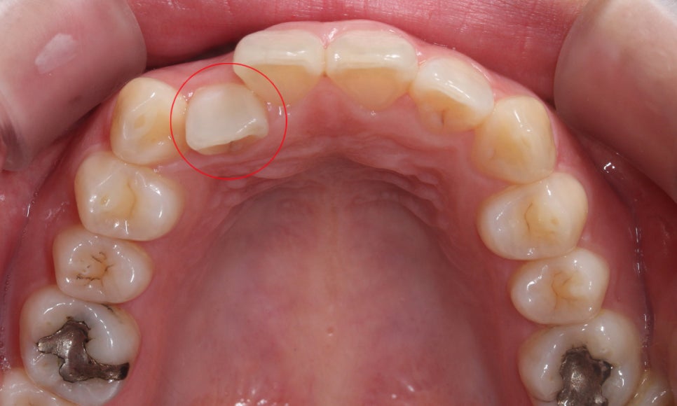 덧니교정 2D교정 (부분교정) 후기 관련 이미지 5