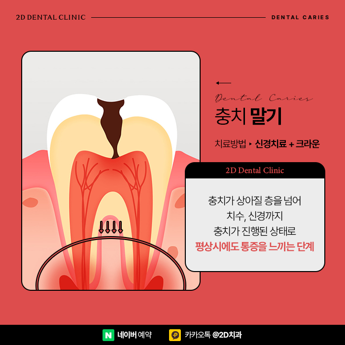 어금니충치치료 빠르게 진행해야 이유, 단계별 레진, 인레이, 크라운 순서 관련 이미지 7