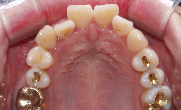 2D치과 2D교정으로 4개월만에 덧니 개선! 관련 이미지 5