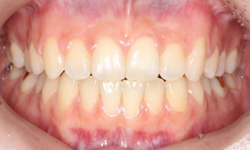 나비앞니 세라믹교정 case 관련 이미지 8