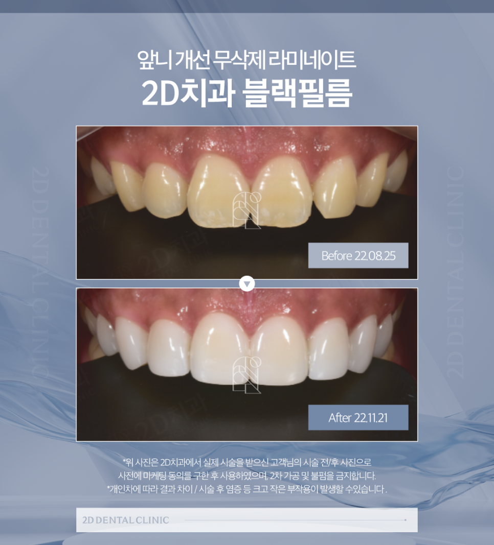 앞니라미네이트가격 다양한 요소를 꼼꼼하게 고려해야 합니다 관련 이미지 7