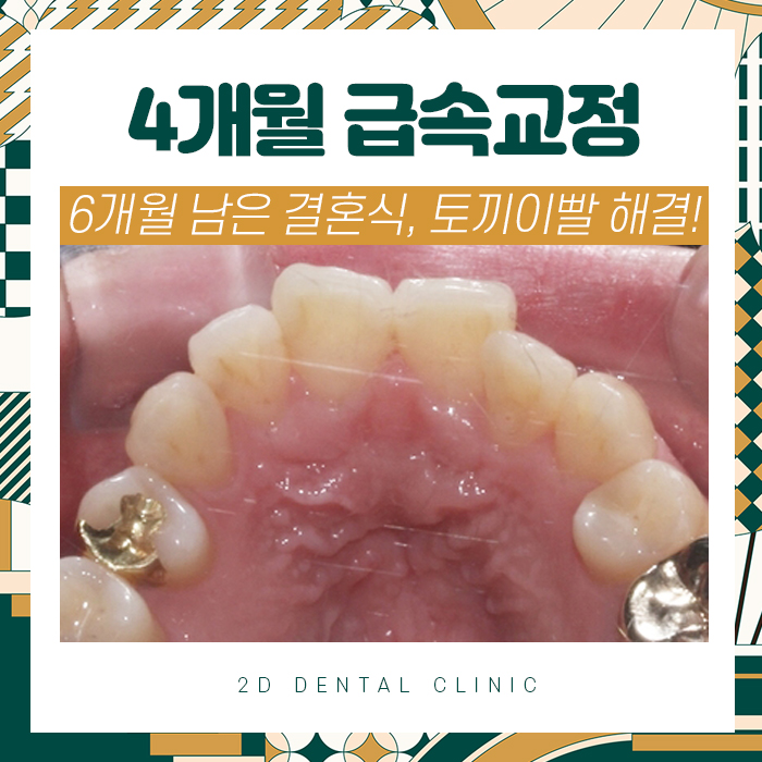 결혼식 6개월 남기고 급속교정으로 토끼이빨 탈출! 관련 이미지 1