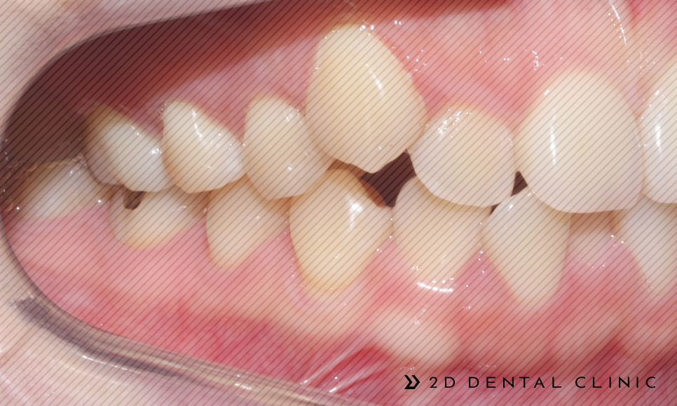 발치교정 돌출입 케이스, 교정전문 2D치과 관련 이미지 13