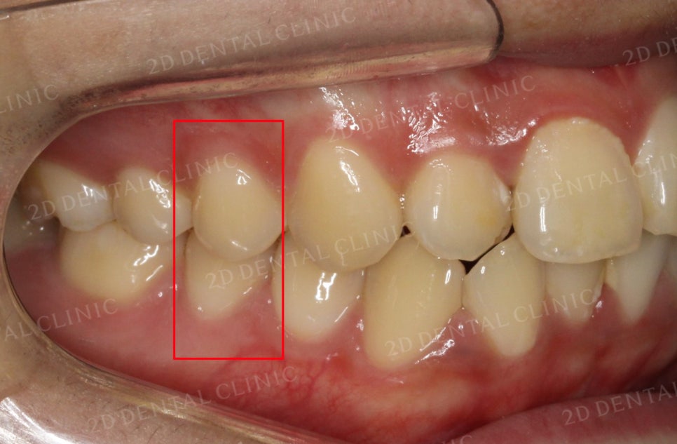 [앞니교정] 토끼앞니교정, 클리피씨 교정으로 완벽하게! by.투디치과(2D치과) 관련 이미지 12