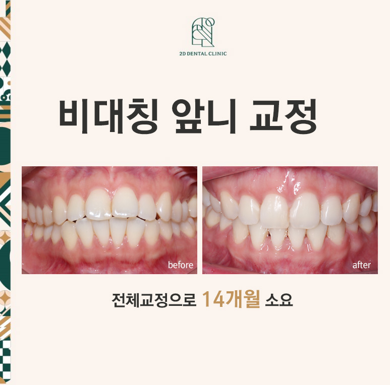 비대칭 앞니, 돌출앞니를 전체 교정으로 교정하고 싶다면!? by.투디치과(2D치과) 관련 이미지 1