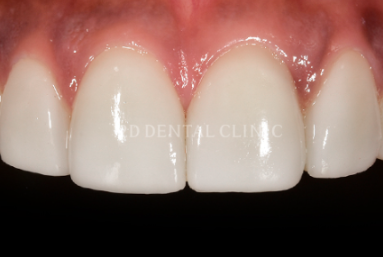 앞니왜소치 치아깨짐 무삭제라미네이트 블랙필름 관련 이미지 5