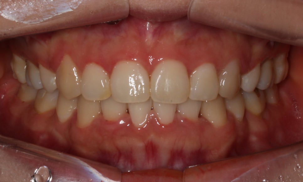 돌출입 탈출기! 덧니 교정도 문제없어! by.투디치과(2D치과) 관련 이미지 3