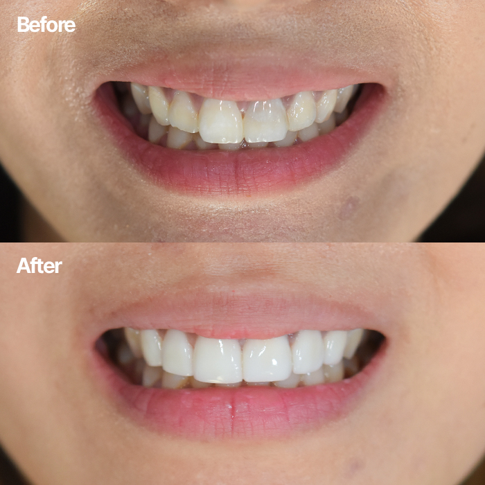 무삭제라미네이트 치아삭제에 대한 부담 없는 후기 관련 이미지 1