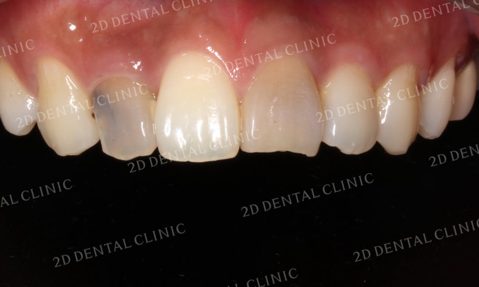 치아변색, 까맣게 변한 변색치를 블링스(Blinx)로 수복하기! by. 투디치과(2D치과) 관련 이미지 5