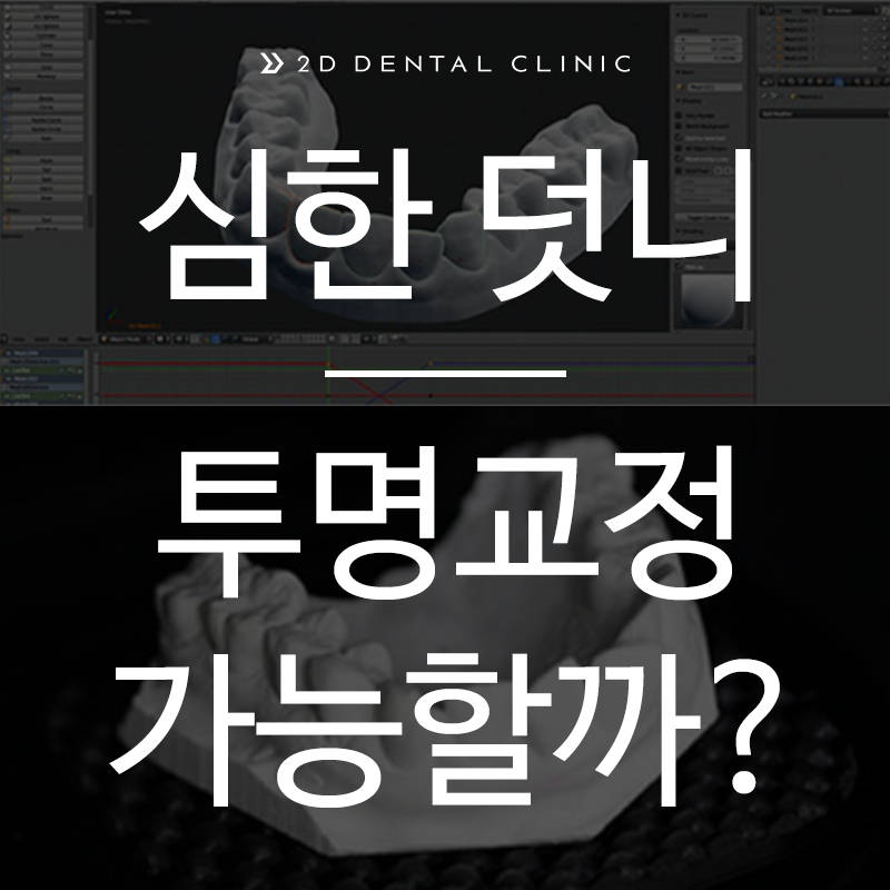 심한 덧니 교정, 투명교정으로 가능할까? 관련 이미지 1