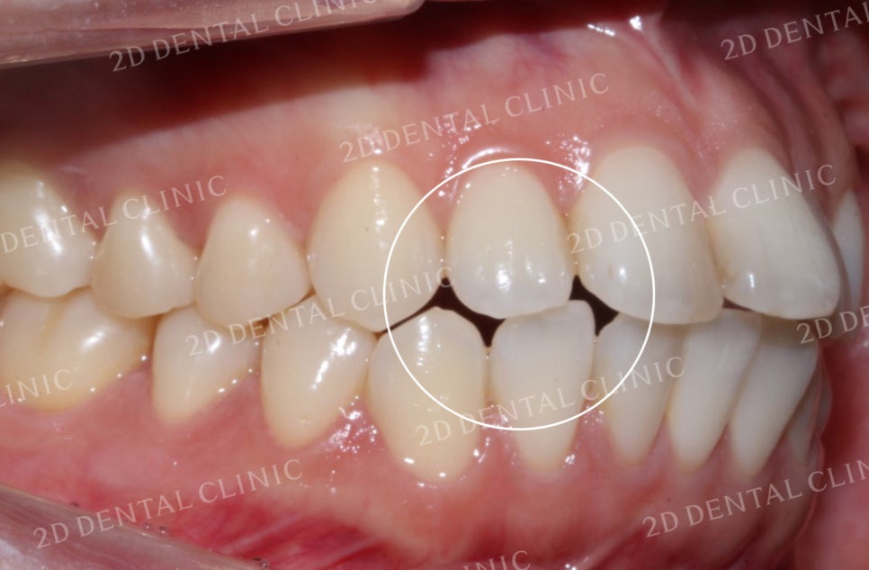 비대칭 앞니, 돌출앞니를 전체 교정으로 교정하고 싶다면!? by.투디치과(2D치과) 관련 이미지 5
