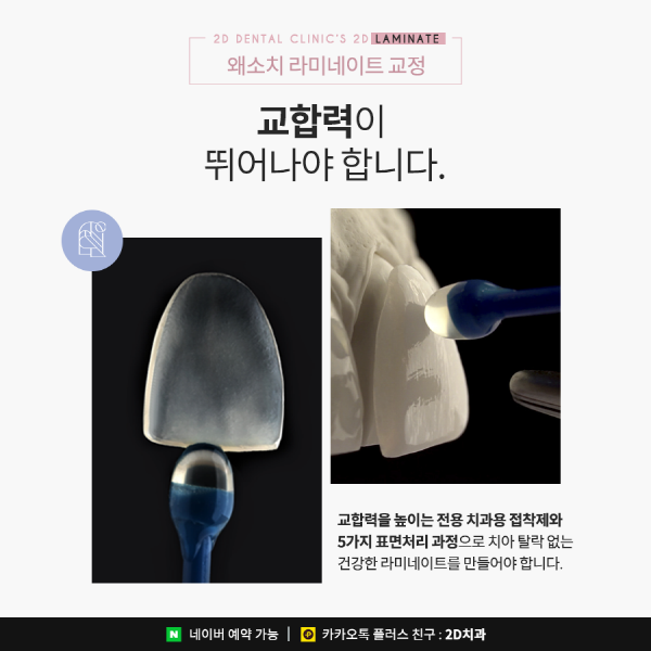 유난히 작은 치아 개선은? 2D 왜소치 라미네이트 교정 관련 이미지 5