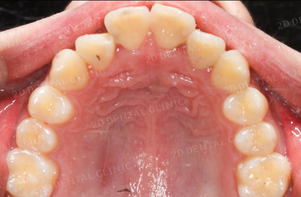 [앞니교정] 토끼앞니교정, 클리피씨 교정으로 완벽하게! by.투디치과(2D치과) 관련 이미지 16