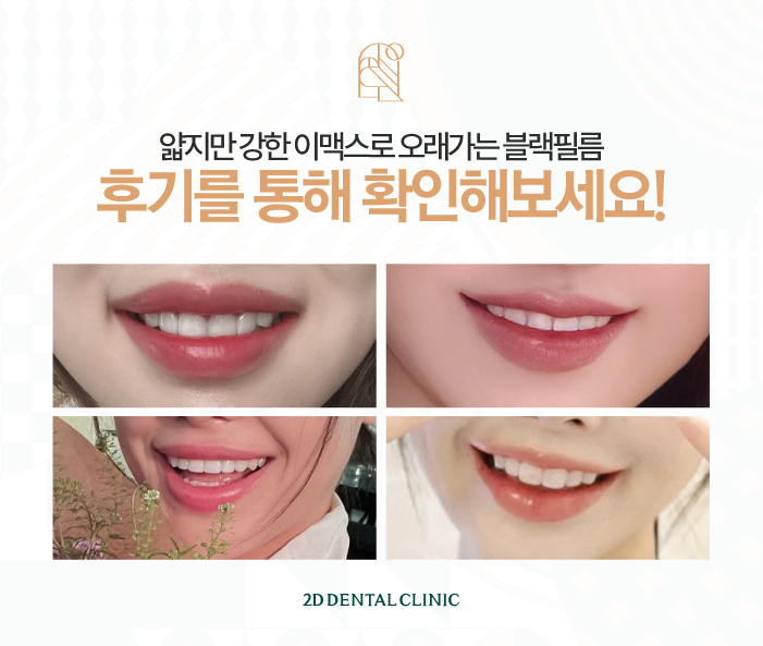 앞니 무삭제라미네이트가격, 후기 부작용 걱정 없이 받아보자! 관련 이미지 6