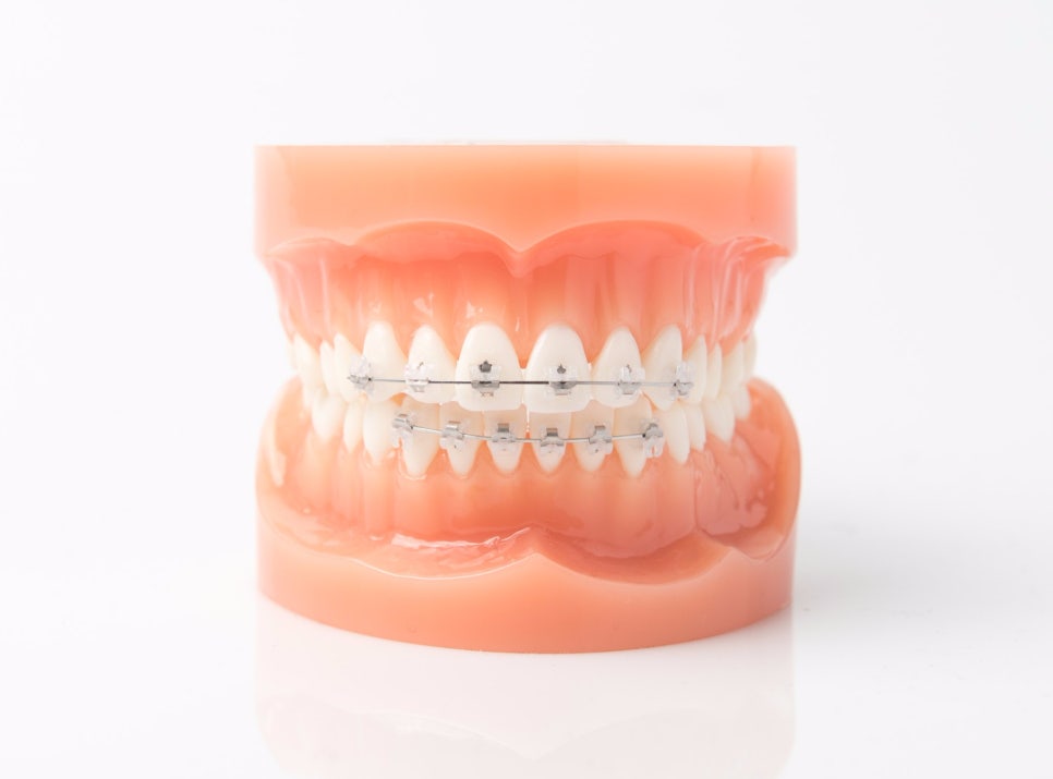 [투디(2D)치과] 교정 와이어의 종류 관련 이미지 3