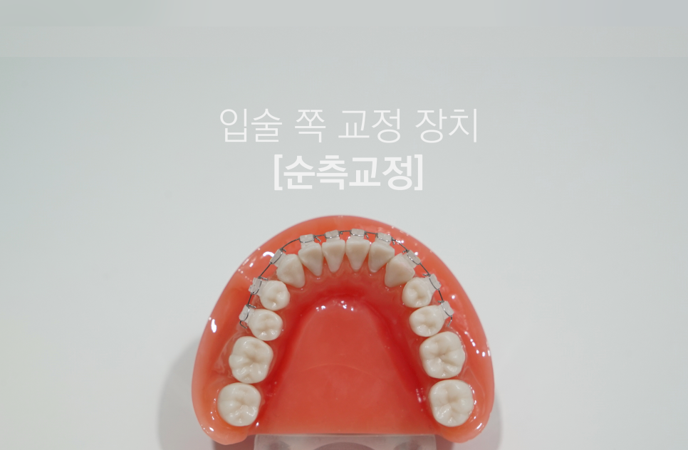 2D(투디)치과!치아교정!클리피씨교정,순측 교정?설측교정? 관련 이미지 4