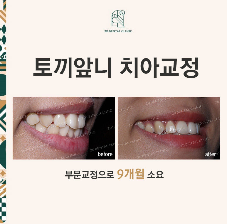 토끼앞니, 튀어나온 앞니 부분교정 후기! by.투디치과(2D치과) 관련 이미지 1
